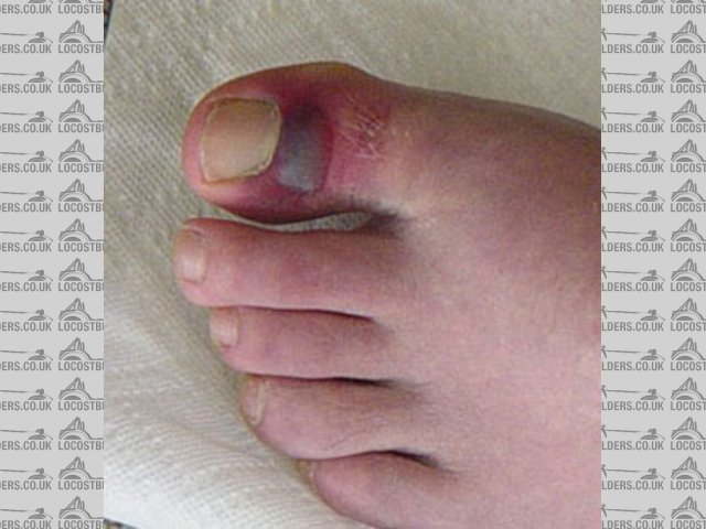 poor sore toe